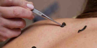 Pengobatan Alami Dengan Menggunakan Lintah terapi lintah